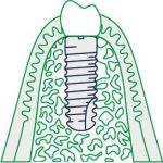 Ankylos - bene saugiausia implantų sistema, kuri neleidžia bakterijoms patekti po dantenų guma (ji užauga ant implanto), dėl unikalaus dizaino