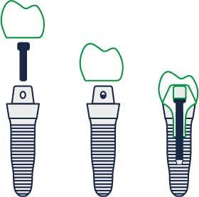 Implantą sudaro karūnėlė (matoma danties dalis), sraigtas, kuris įsukamas į kaulą ir specialus varžtas, sujungiantis karūnėle ir sraigą.