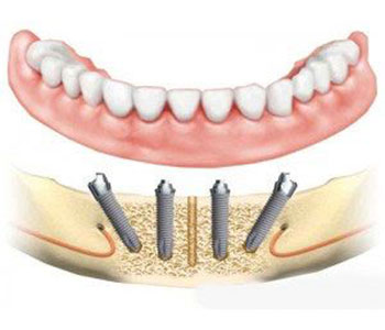 What Does How Much Does Zoom Teeth Whitening Cost Mean Cormanhb38