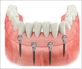 mdibiase_bocca-mini-impianti-dentali-c-tech-implant