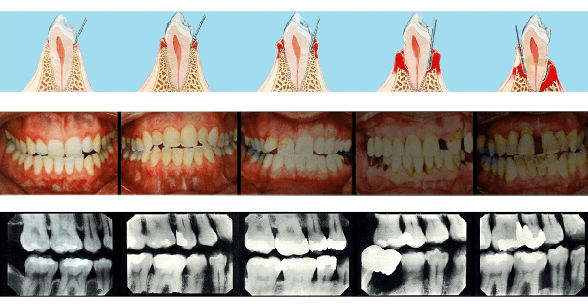 Periodontitas - klastinga liga. Sužinokite svarbiausius faktus