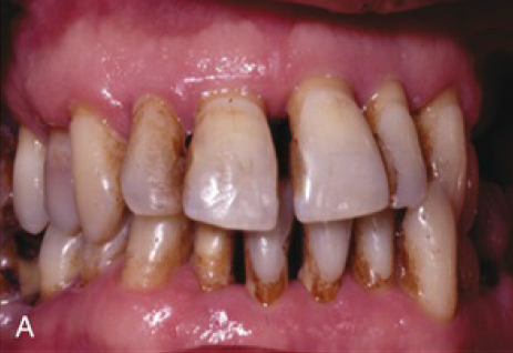 Periodontitas