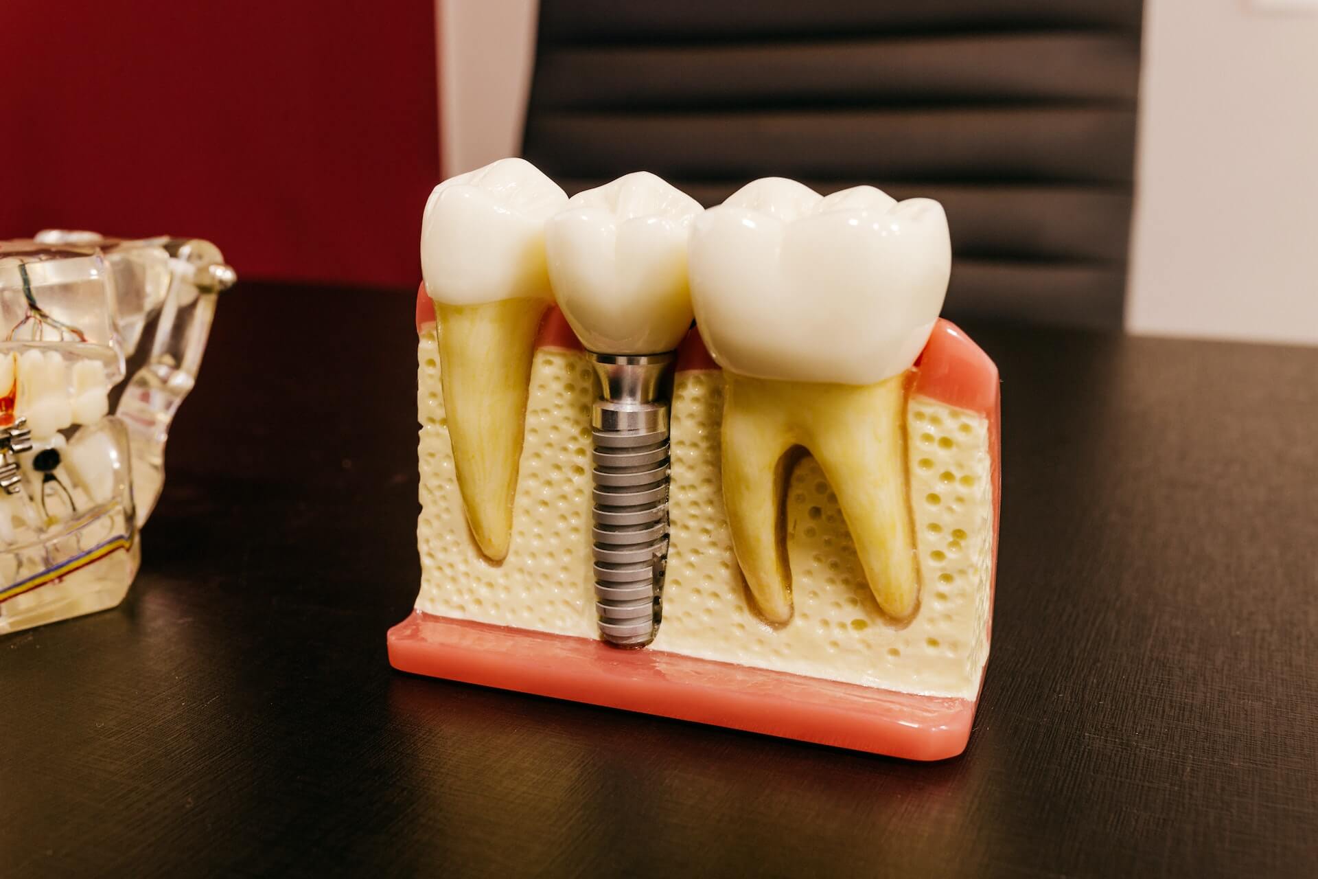 Dantų implantai - ilgalaikė investicija