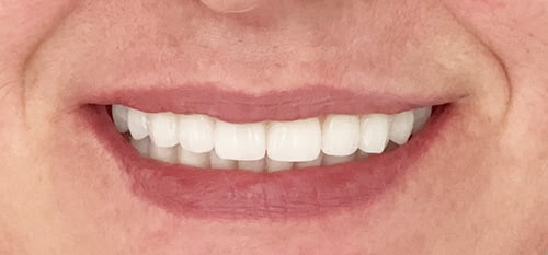 Visi dantys ant keturių implantų - rezultatas - Papadent