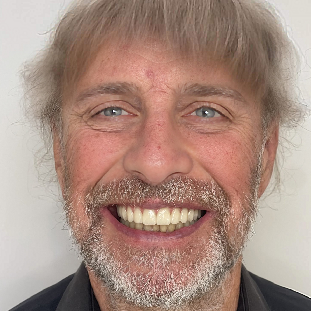 Danius šypsosi po All-on-4 implantacijos procedūros