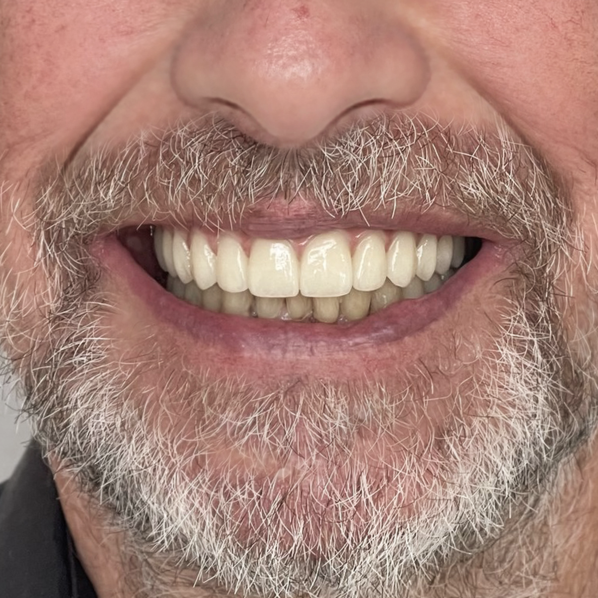 Viso žandikaulio implantacija Dainiui