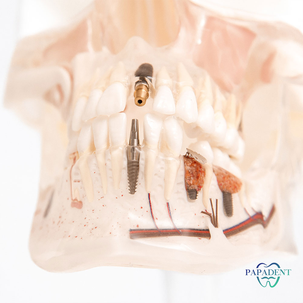 Įvairūs dantų implantai