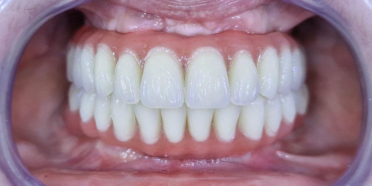 Po - Gintarė - pašalinti 11 viršutinio ir 8 apatinio žandikaulio dantys