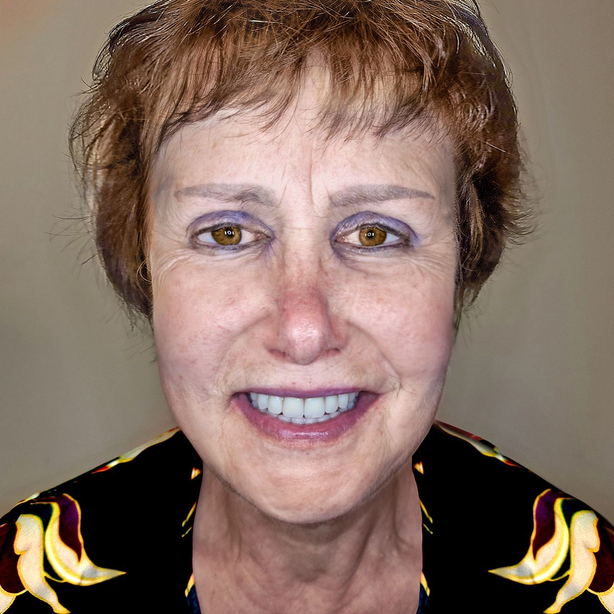 natalijos sypsena istacius visu dantu implantus