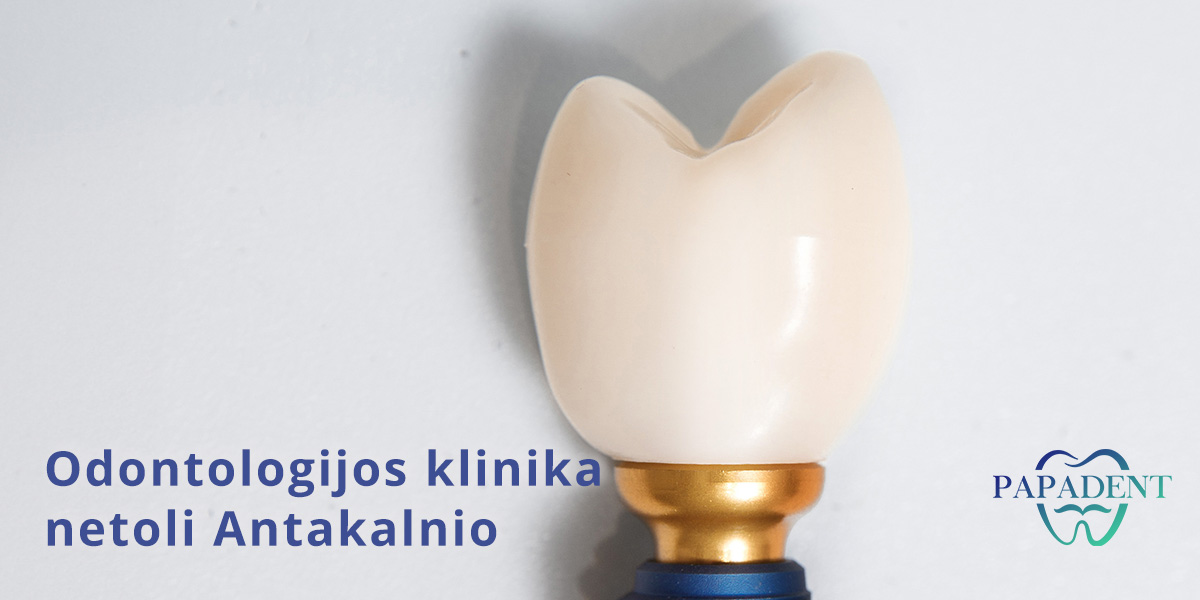 Dantų implantacija Antakalnyje