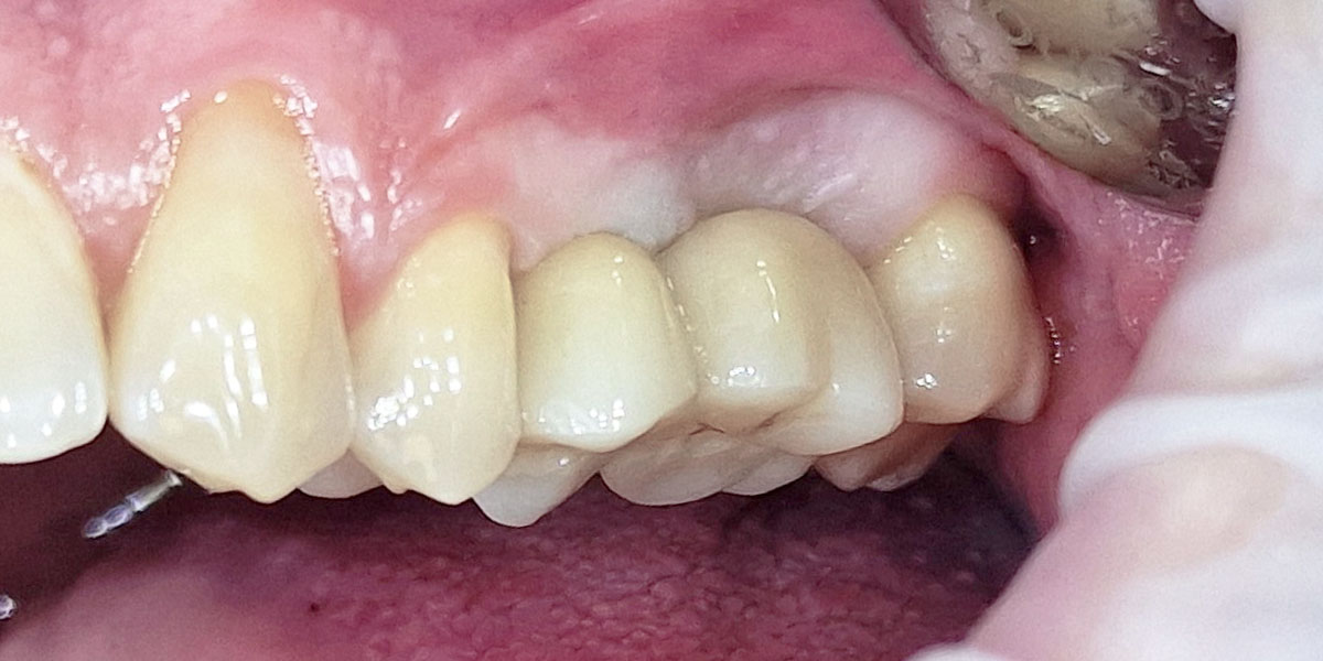 Po - įsriegti du krūminio danties implantai