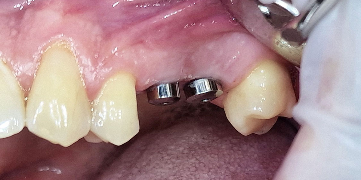 Prieš - įsriegti du krūminio danties implantai