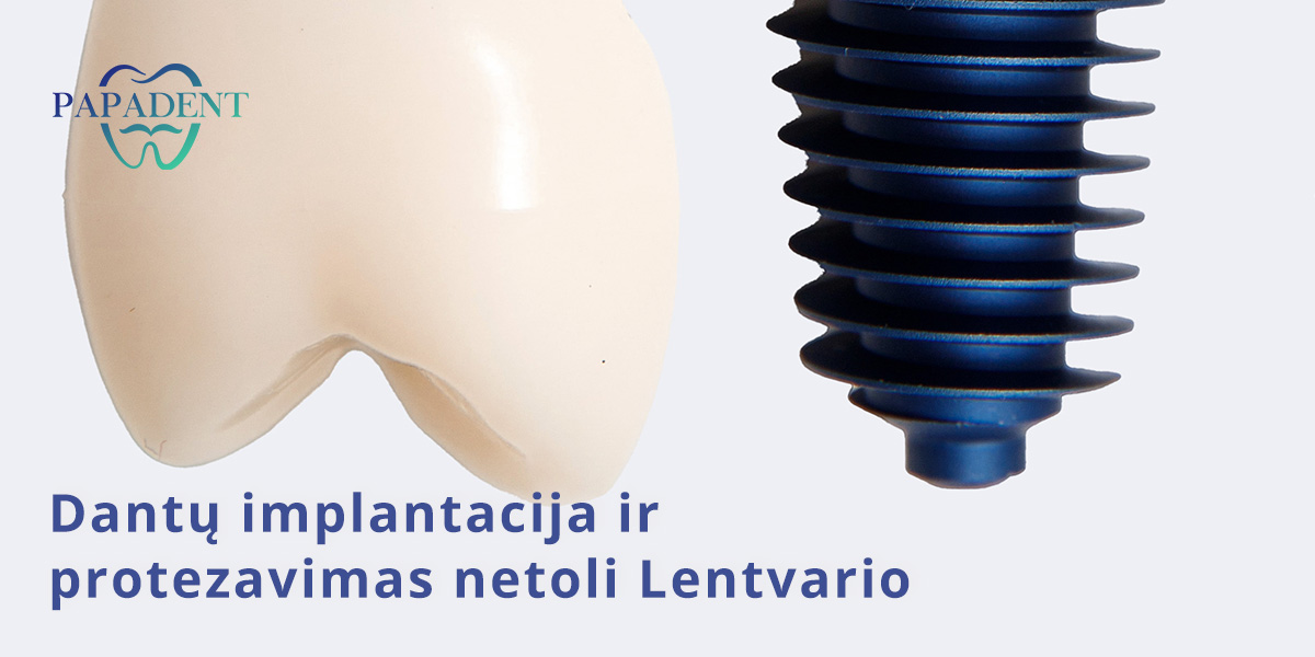 Dantų implantacija Lentvaryje