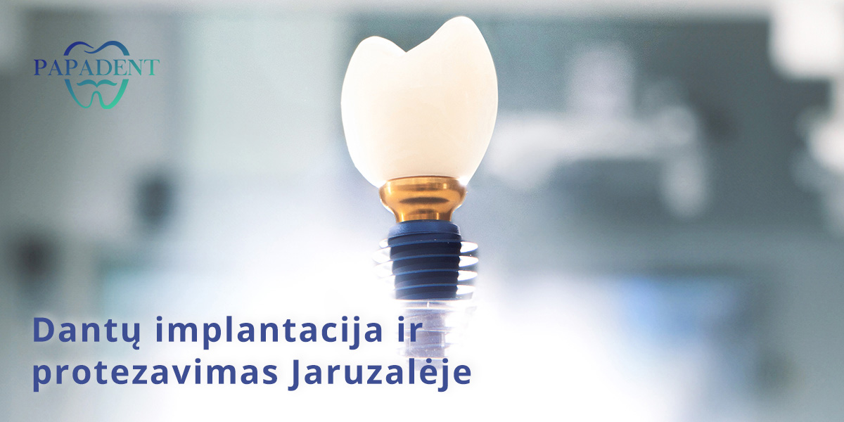 Dantų implantacija Jaruzalėje