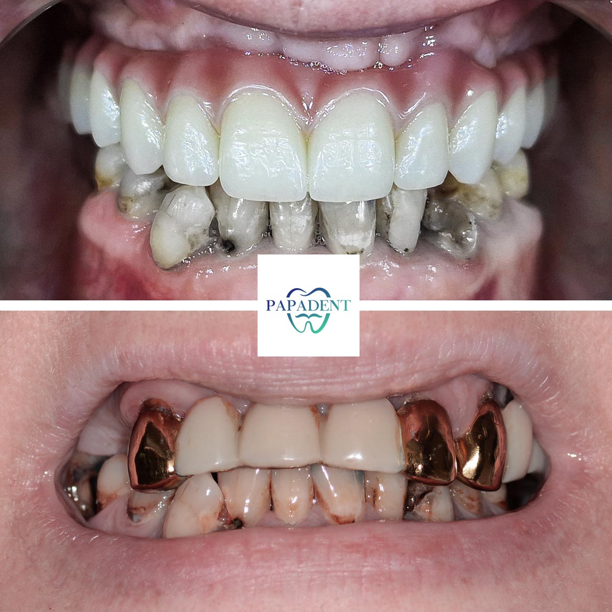 Vitalija - All-on-4 dantų protezai - prieš ir po 1