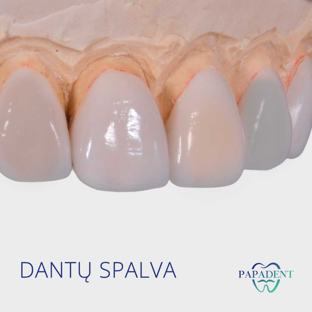 Dantų spalva
