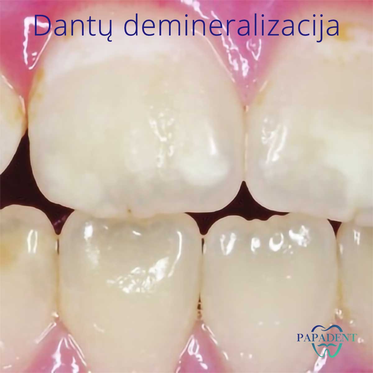 Dantų demineralizacija