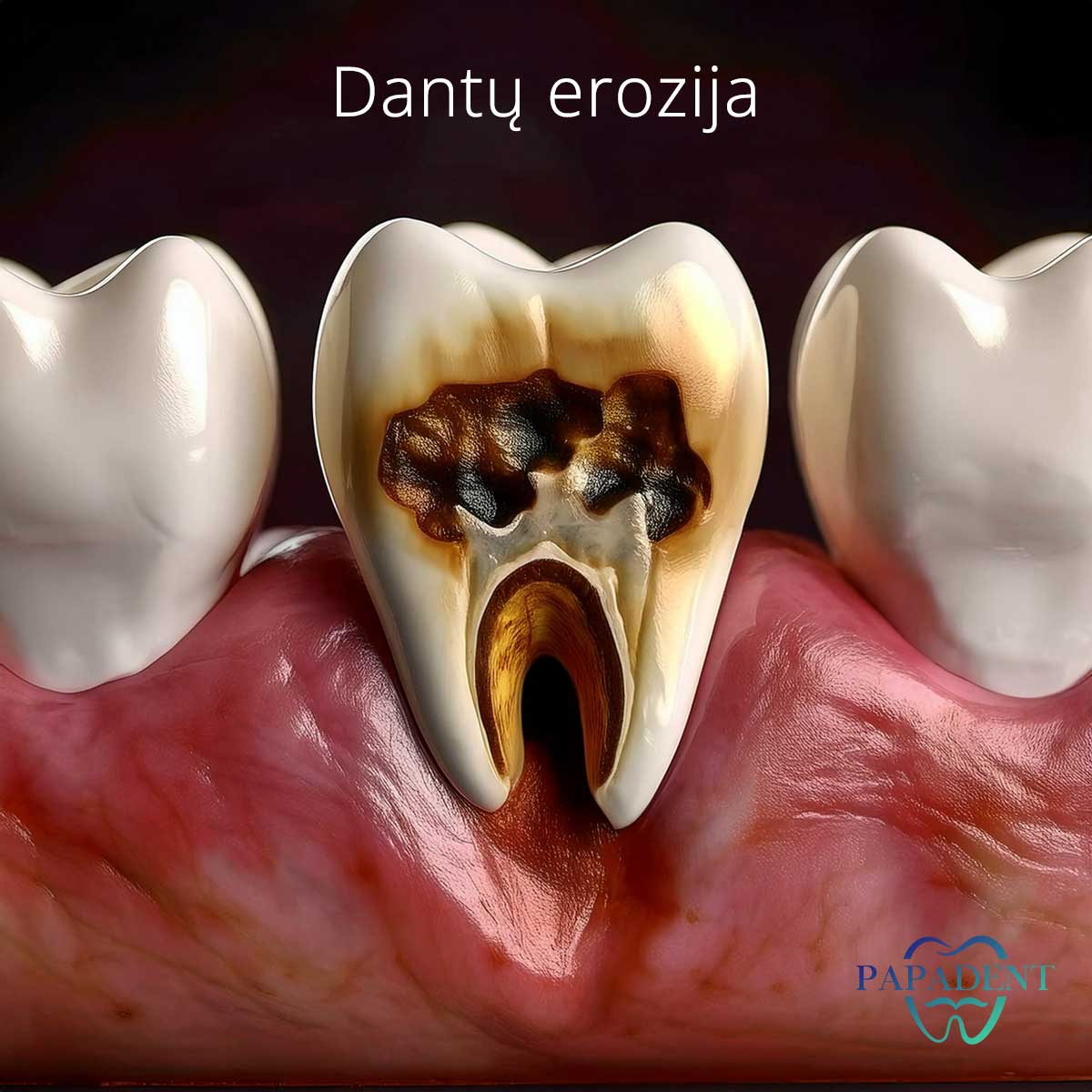Dantų erozija